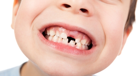 Cuidado de los niños: caída de los dientes de leche