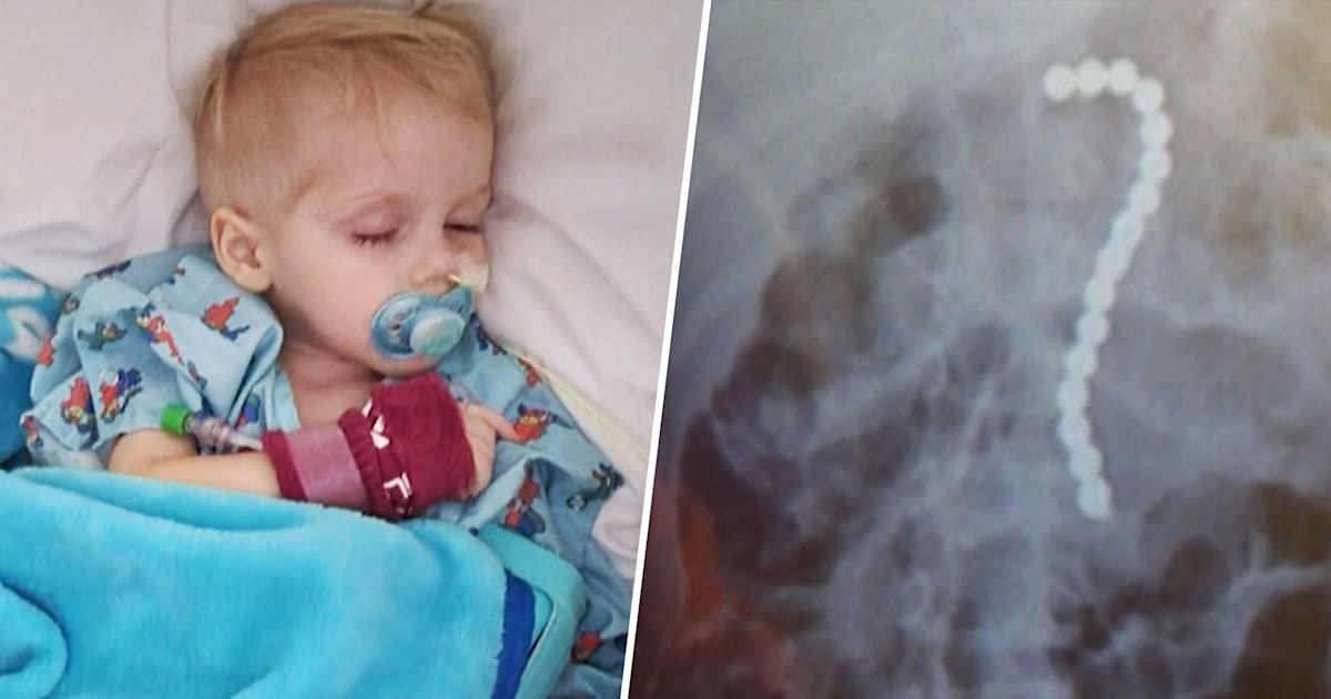Un niño de Florida, de 2 años, hospitalizado tras tragarse 16 bolas magnéticas