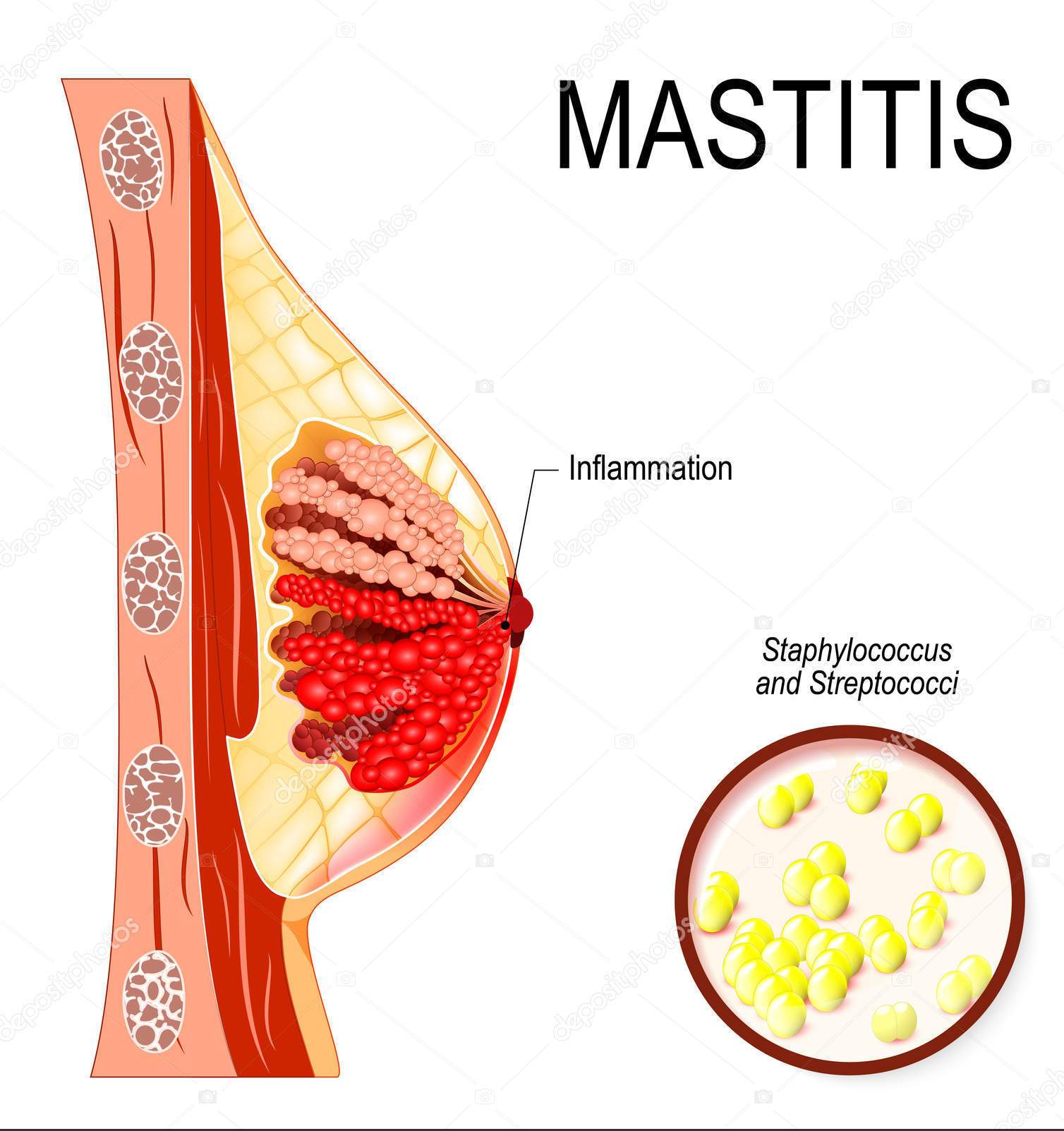 Conceptos básicos de la infección mamaria