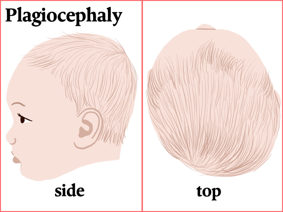 Plagiocefalia-Síndrome de la cabeza plana