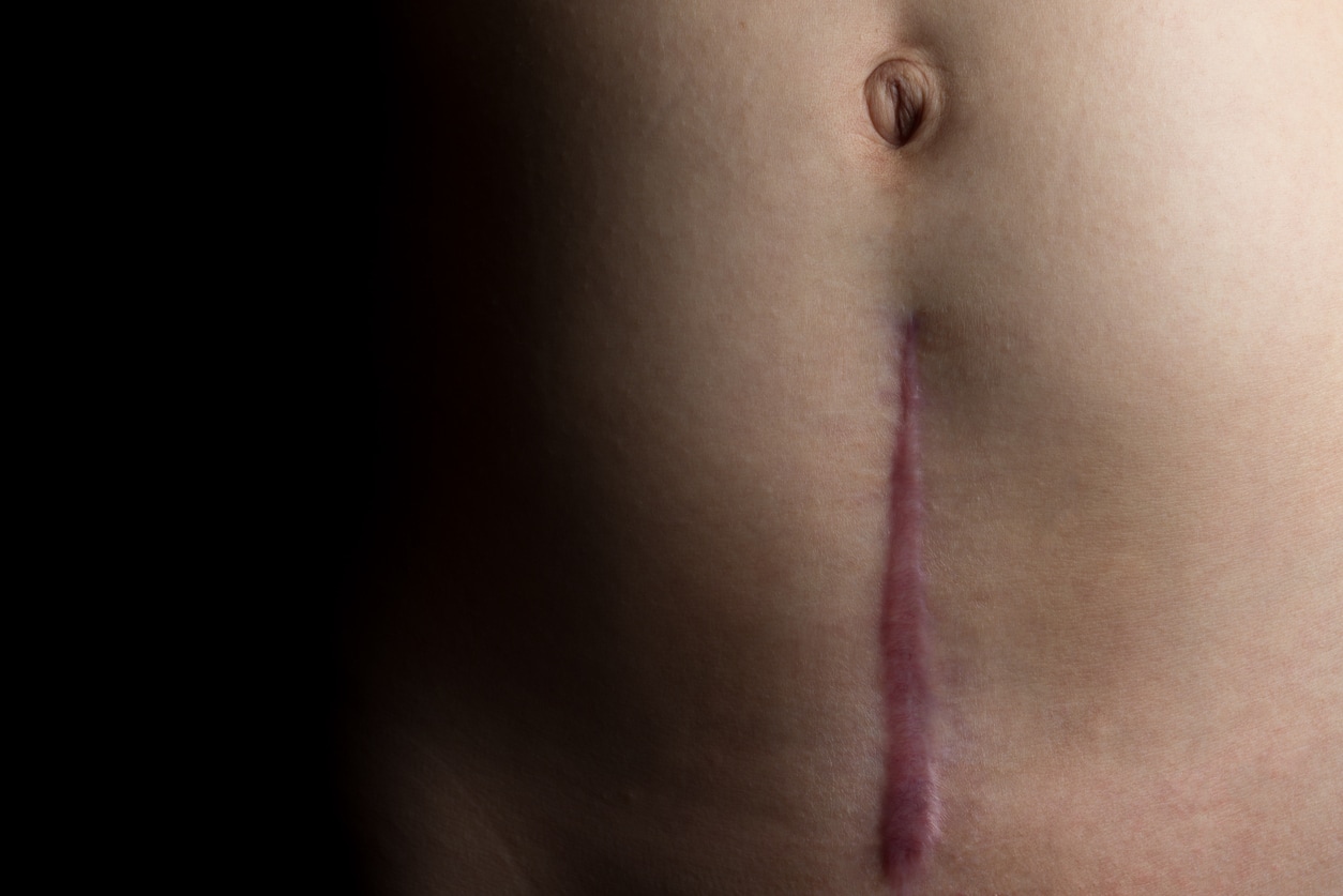 Cómo cuidar la cicatriz de la cesárea para una cicatrización sana