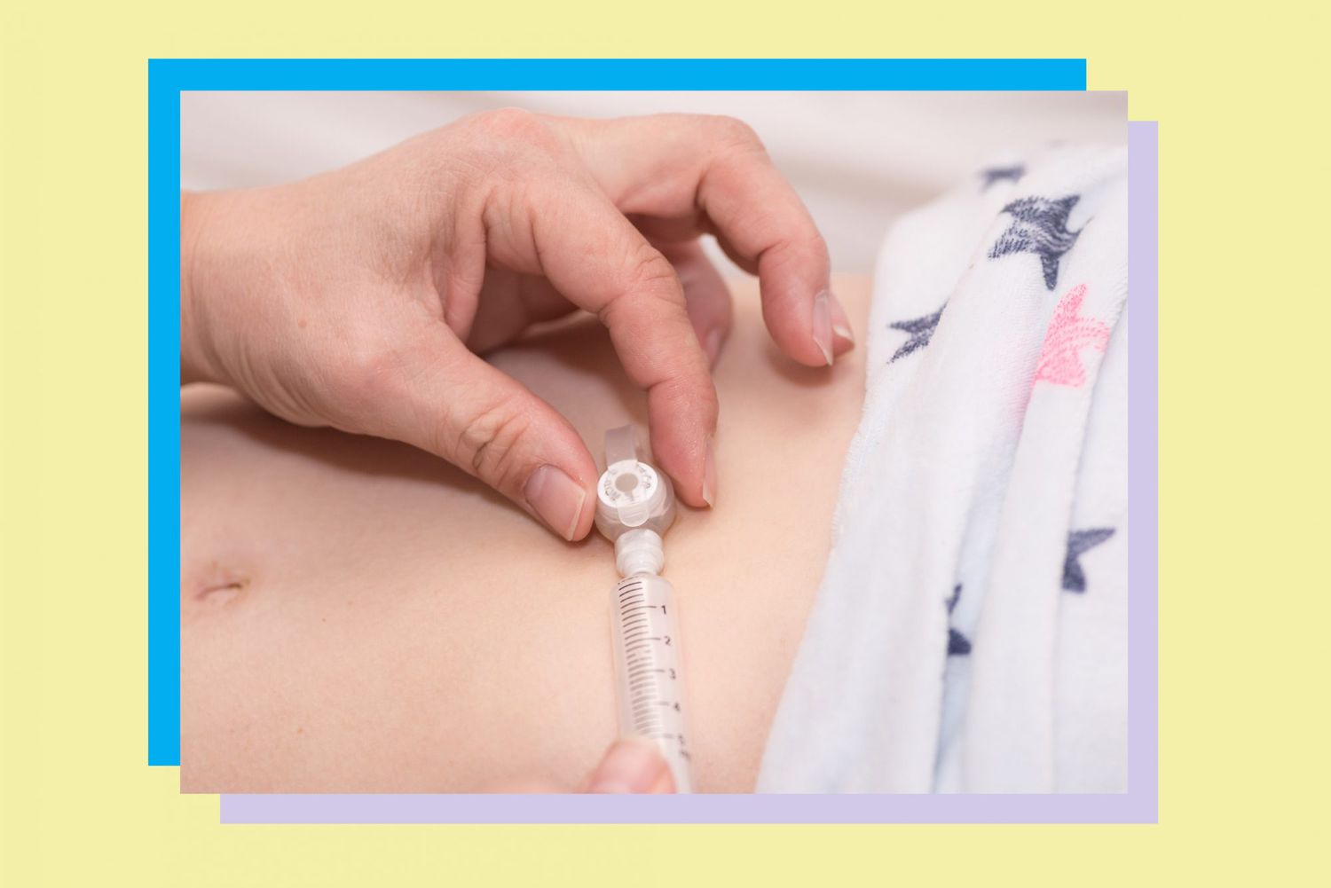 ¿Tiene un hijo alimentado por sonda? Estos son 5 tipos de suministros que necesita lo antes posible