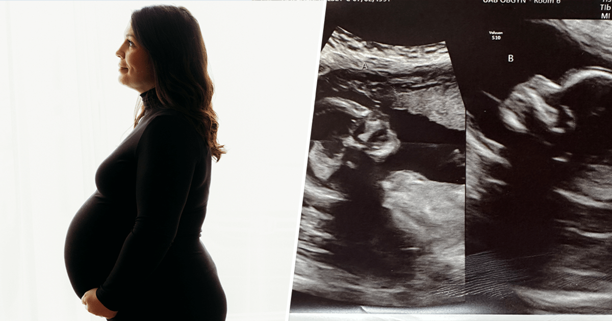 Una mujer de Alabama con un extraño útero doble espera un hijo en ambos