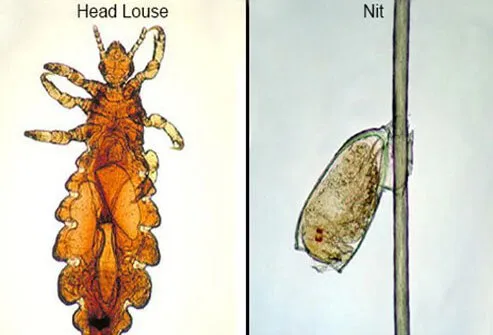 El piojo de cabeza común es un insecto que se adhiere al cuero cabelludo y se alimenta de la sangre humana.