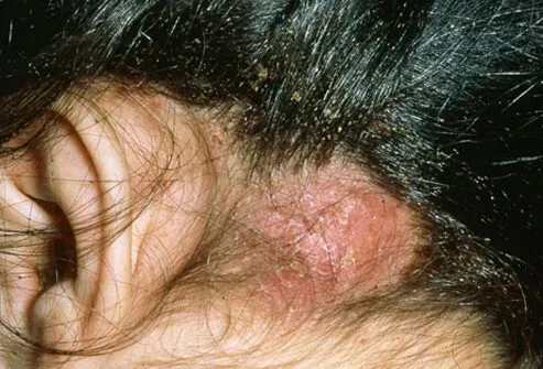 Para las personas que desarrollan una reacción alérgica a los piojos, existe el riesgo de desarrollar una infección bacteriana debido al daño de la piel y al rascado excesivo.